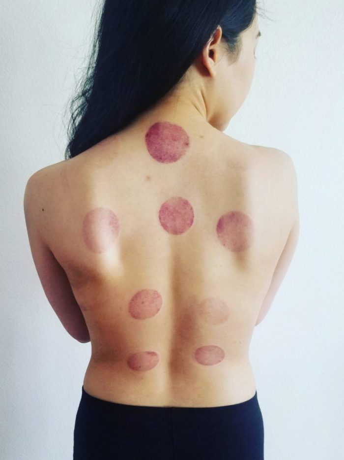 Cupping & Acupuncture for TMJ – My first-hand experience with treatment